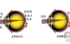 导致近视的原因,揭开视力下降的神秘面纱